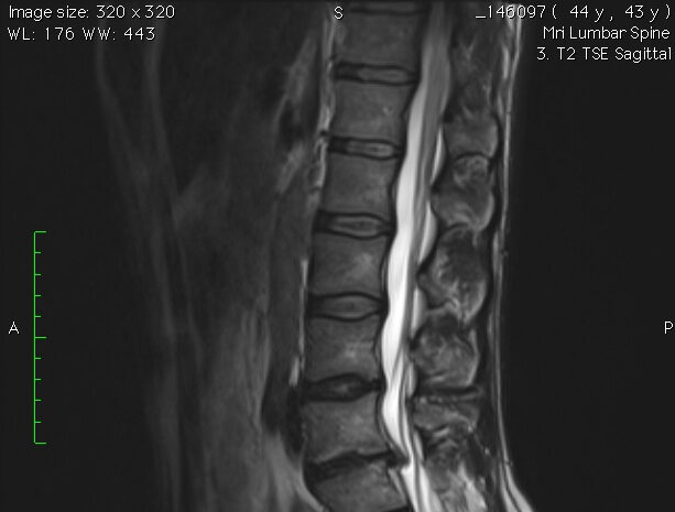Lower back pain - herniated disc